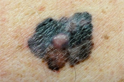 Study shows decreasing melanoma rates among under 40s in Queensland