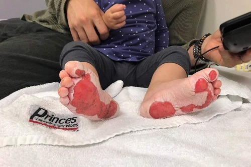 Toddler suffers severe burns to feet after stepping on metal plate in Ipswich park